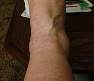 My Screaming Ankle